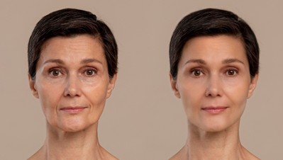 hydrafacial 1