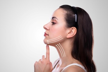 kybella reduce double chin 2