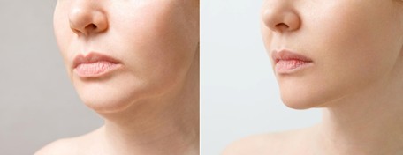 kybella reduce double chin