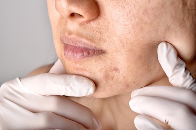 morpheus for acne scars