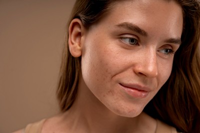 morpheus for acne scars