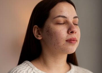 morpheus for acne scars