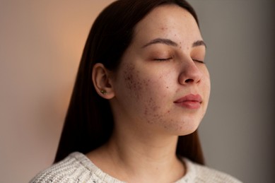 morpheus for acne scars morpheus for acne scars